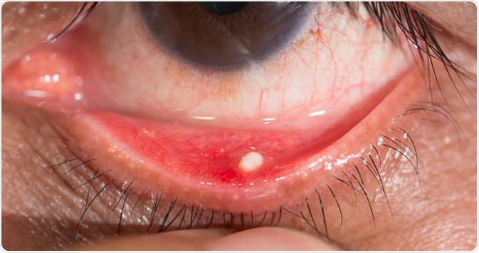 Close up of the chronic conjunctivitis with concretion during eye examination. Image Credit: ARZTSAMUI / Shutterstock
